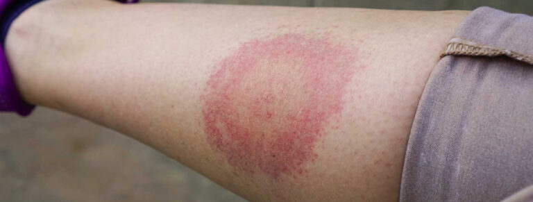 Ağır yanık geçiren kadınlarda kan enfeksiyonu riski erkeklerden yüksek